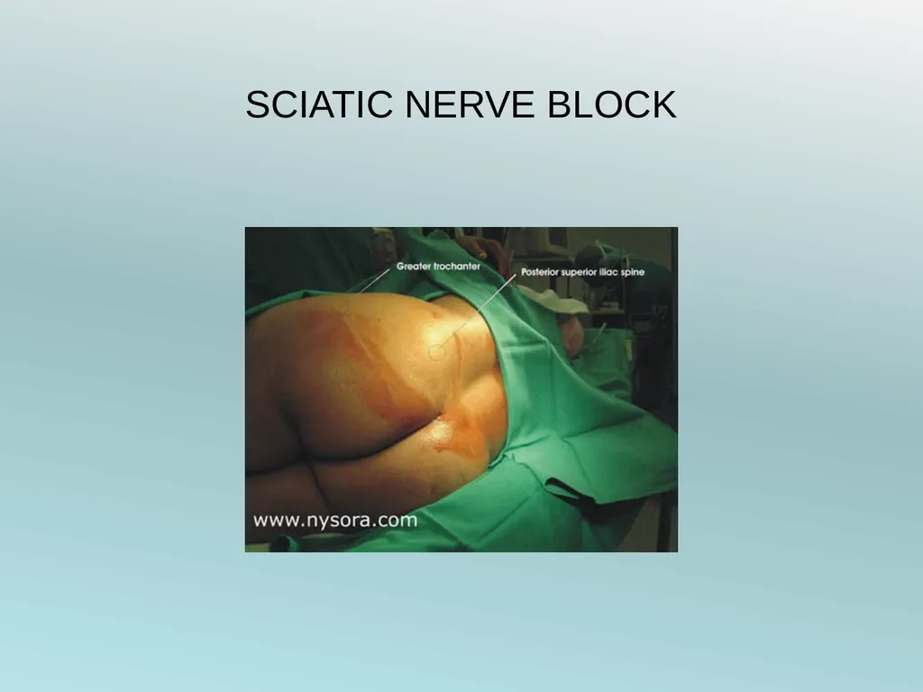 Surgery Under Regional Anesthesia Jean Daniel - slide 50 of 76
