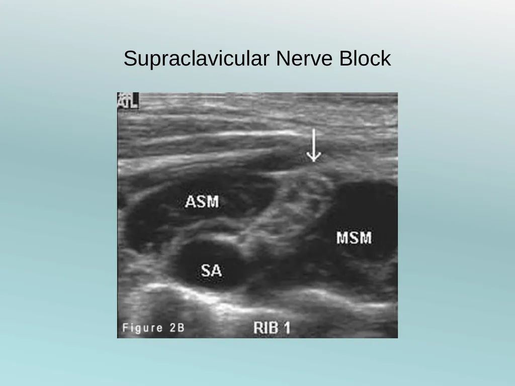 Surgery Under Regional Anesthesia Jean Daniel - slide 15 of 76