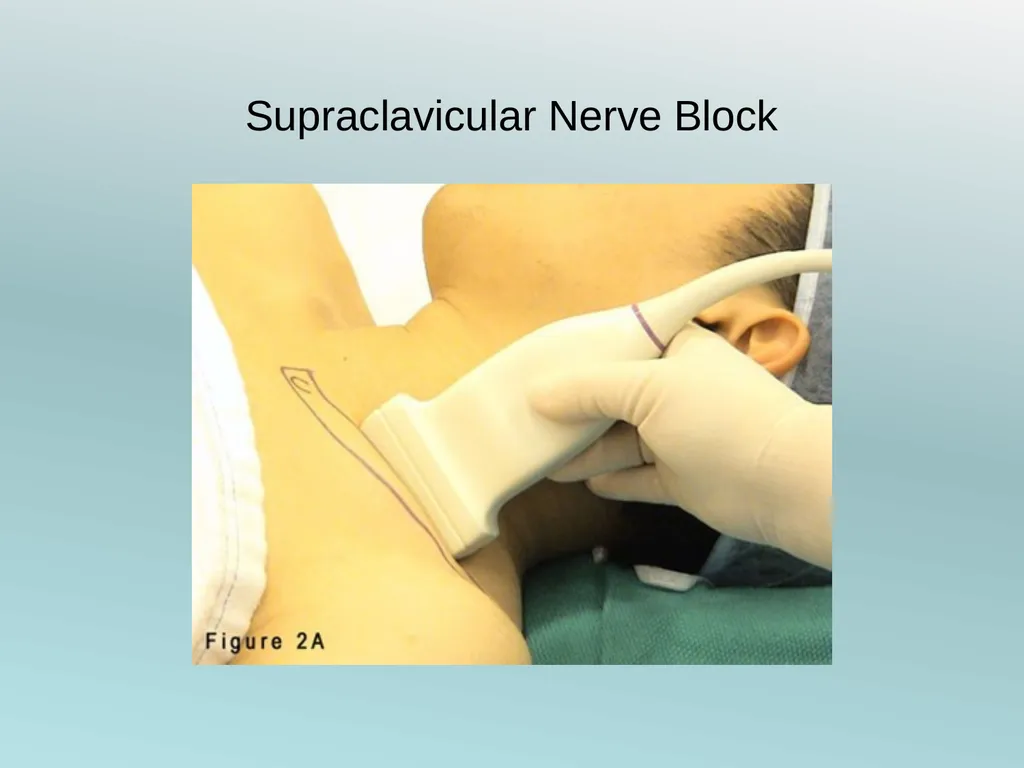 Surgery Under Regional Anesthesia Jean Daniel - slide 16 of 76