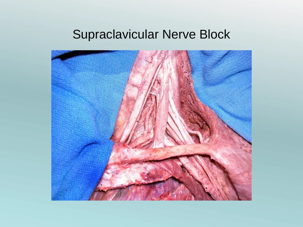 Surgery Under Regional Anesthesia Jean Daniel - slide 17 of 76