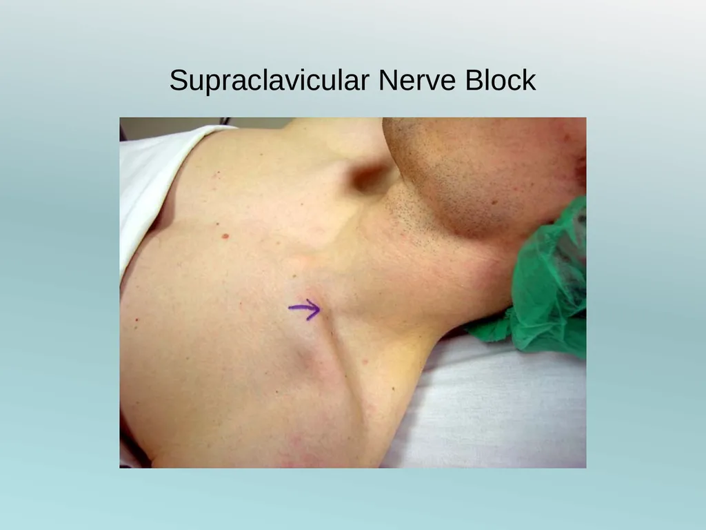 Surgery Under Regional Anesthesia Jean Daniel - slide 19 of 76