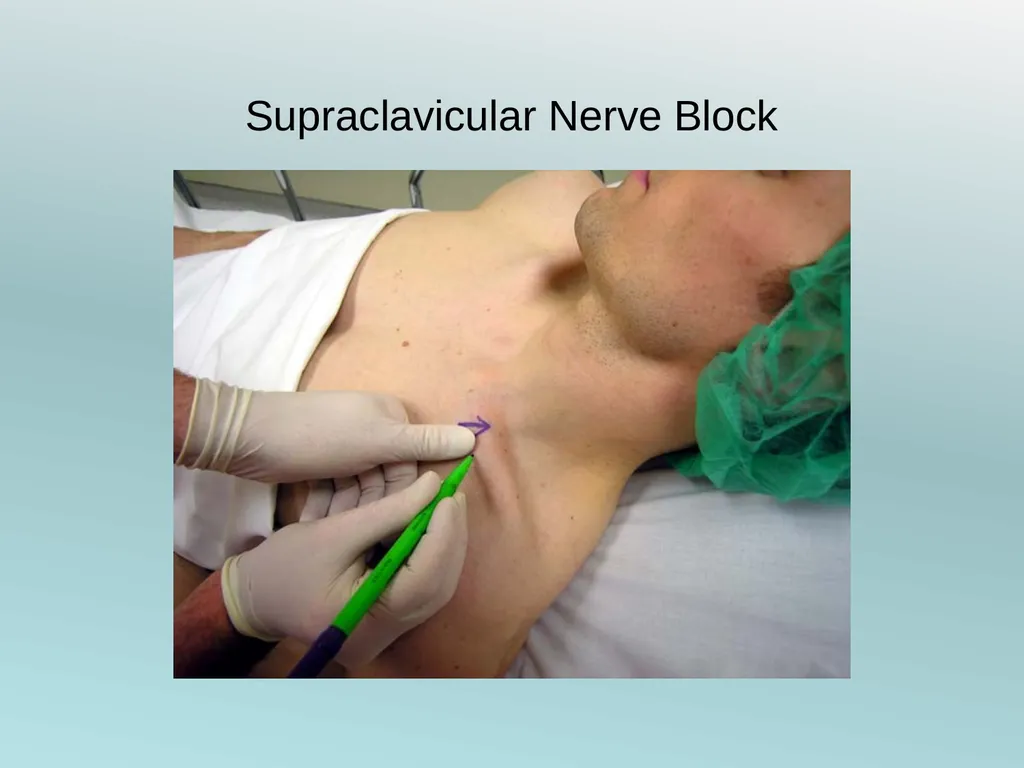 Surgery Under Regional Anesthesia Jean Daniel - slide 20 of 76