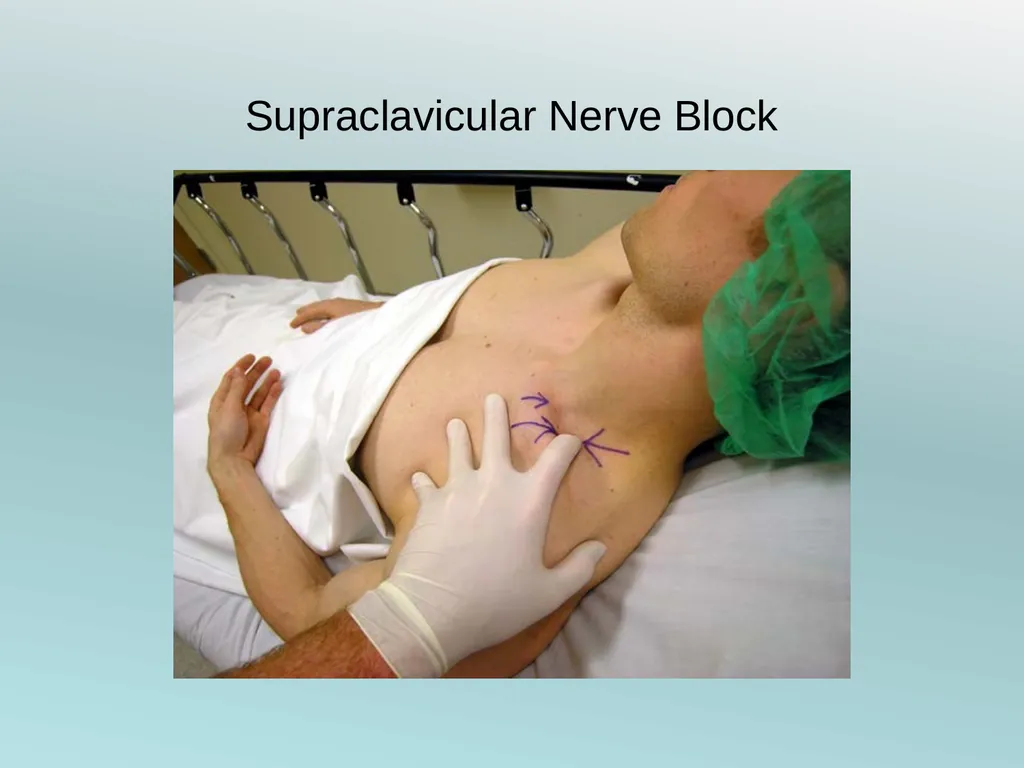 Surgery Under Regional Anesthesia Jean Daniel - slide 21 of 76