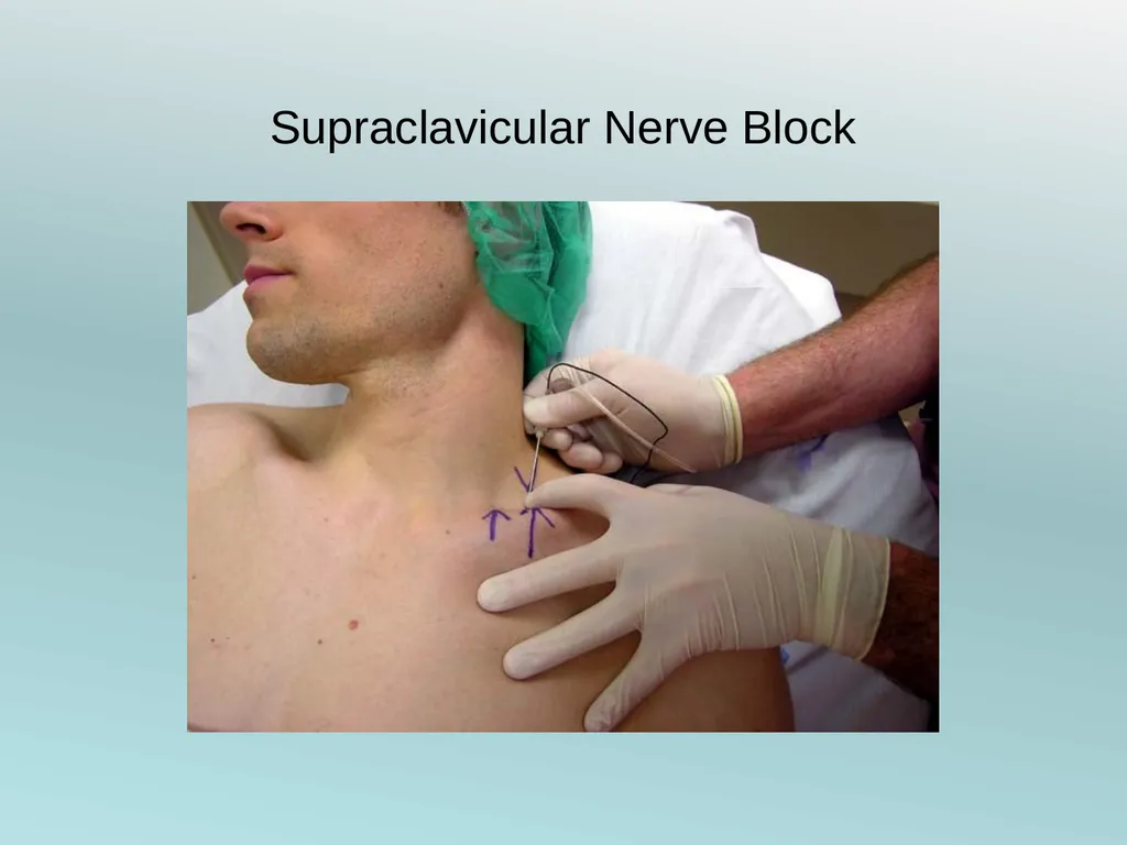Surgery Under Regional Anesthesia Jean Daniel - slide 22 of 76