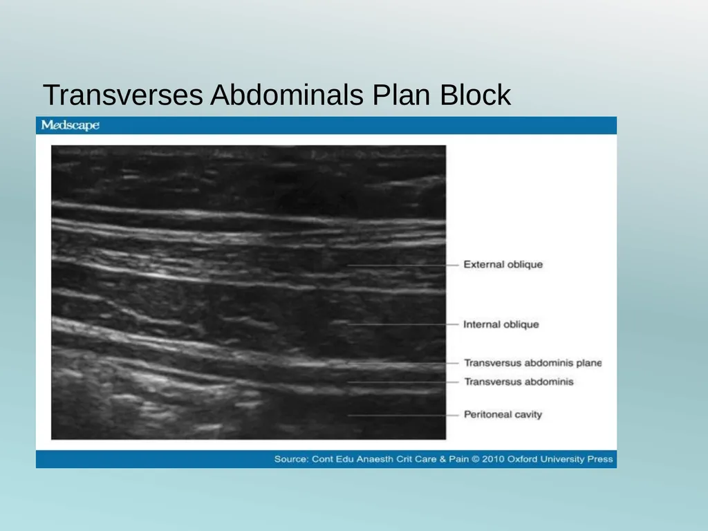Surgery Under Regional Anesthesia Jean Daniel - slide 76 of 76