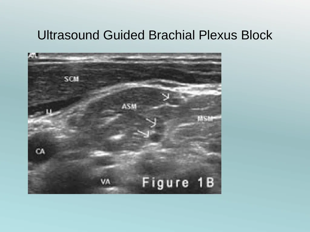 Surgery Under Regional Anesthesia Jean Daniel - slide 10 of 76