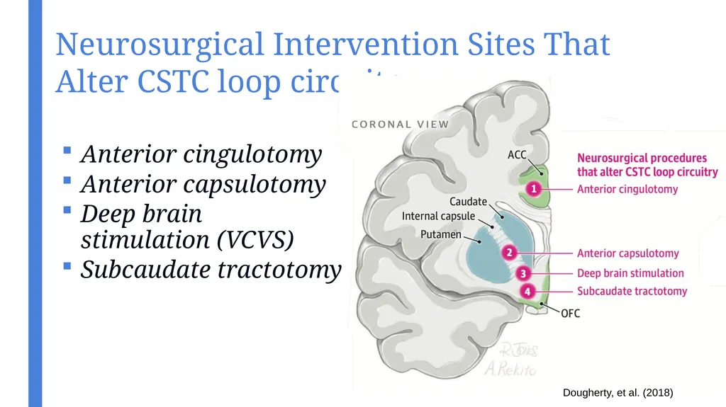 An Introduction to Transcranial Magnetic - slide 23 of 48