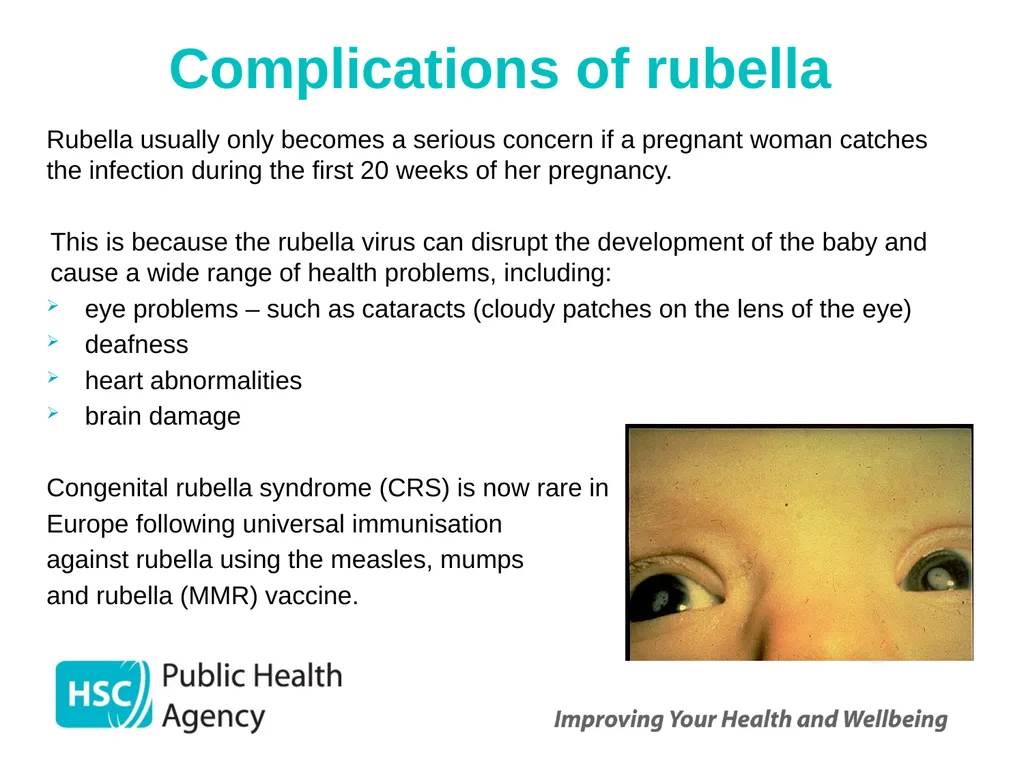 Measles, mumps and rubella Prepared by the PHA - slide 25 of 49