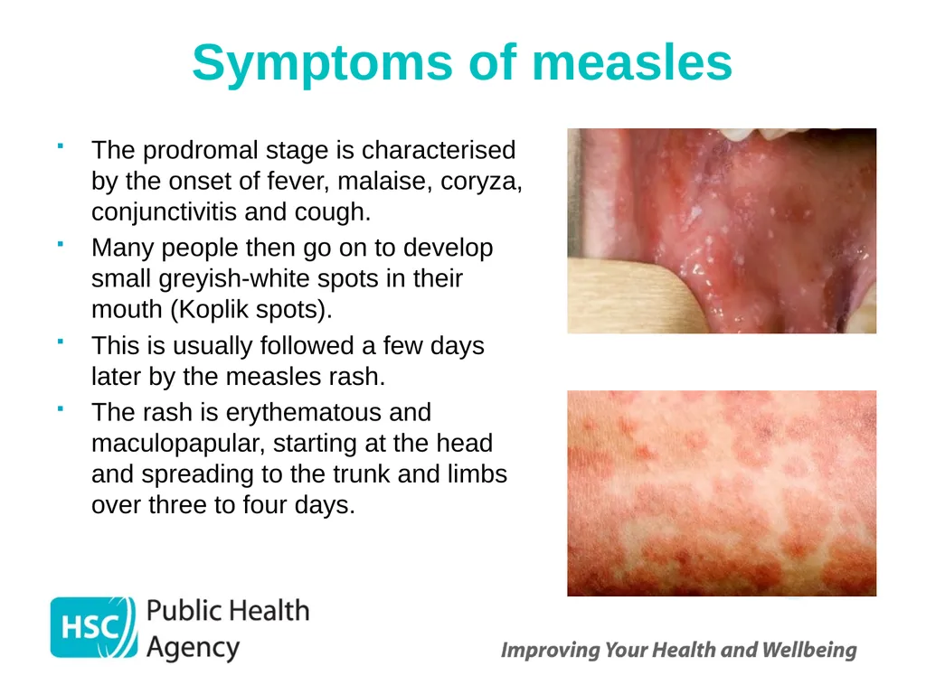 Measles, mumps and rubella Prepared by the PHA - slide 4 of 49