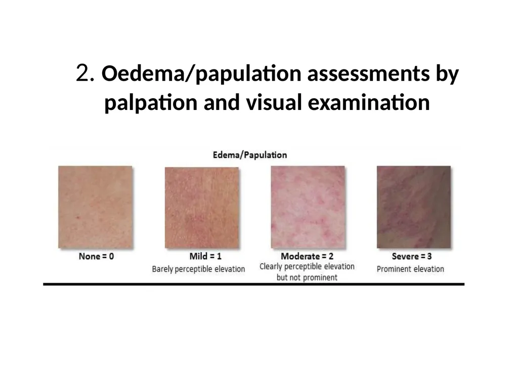 Introduction to assessing the severity of eczema - slide 9 of 40