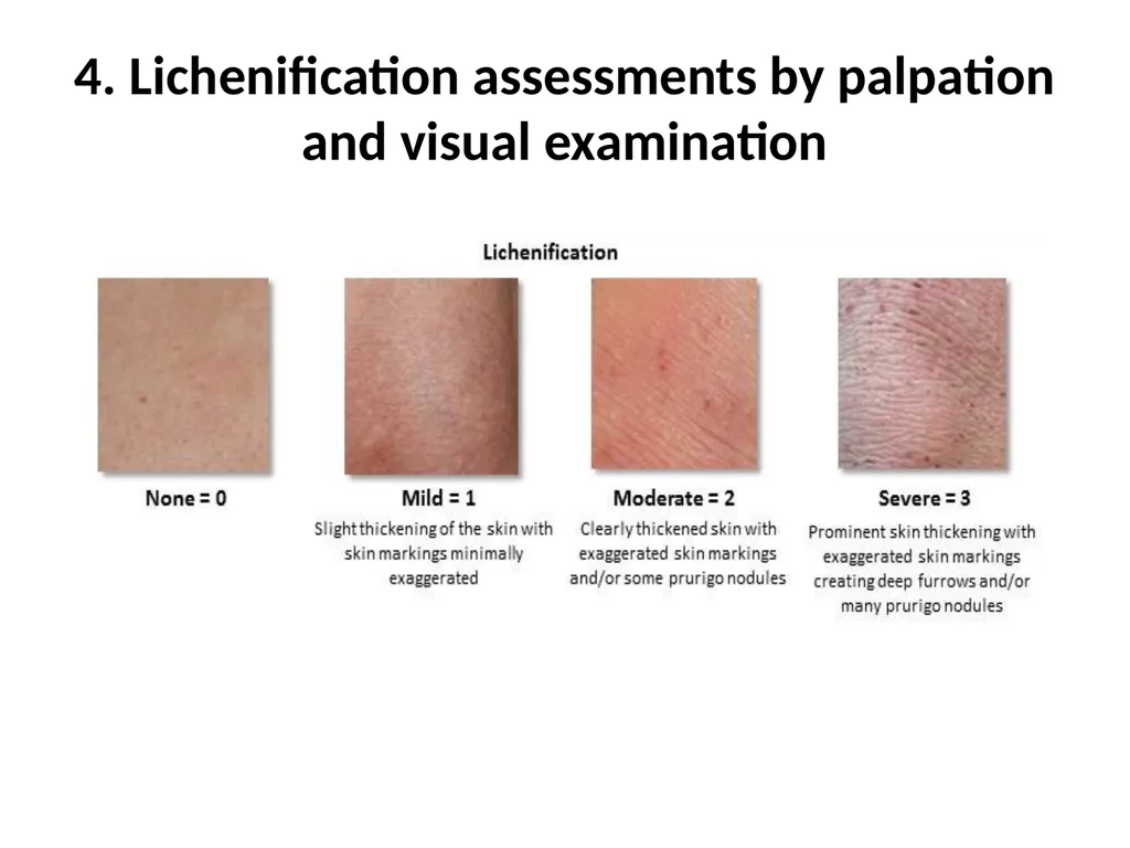 Introduction to assessing the severity of eczema - slide 19 of 40