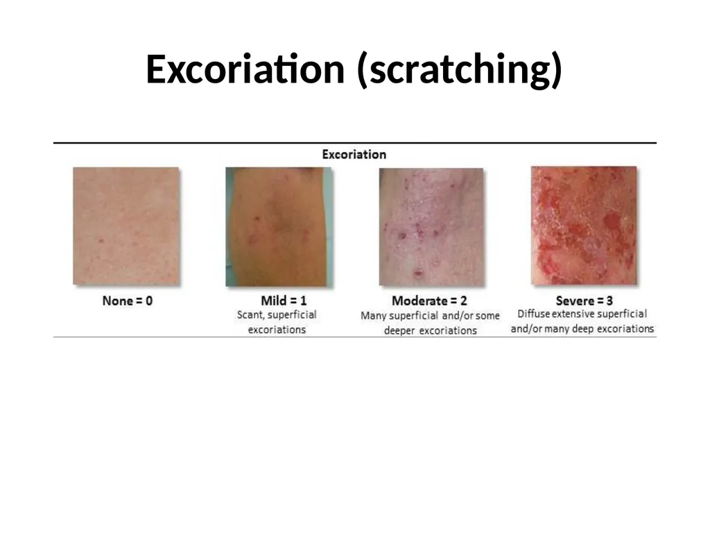 Introduction to assessing the severity of eczema - slide 15 of 40