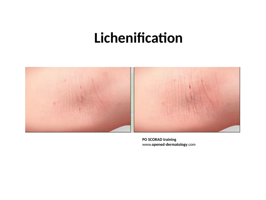 Introduction to assessing the severity of eczema - slide 20 of 40