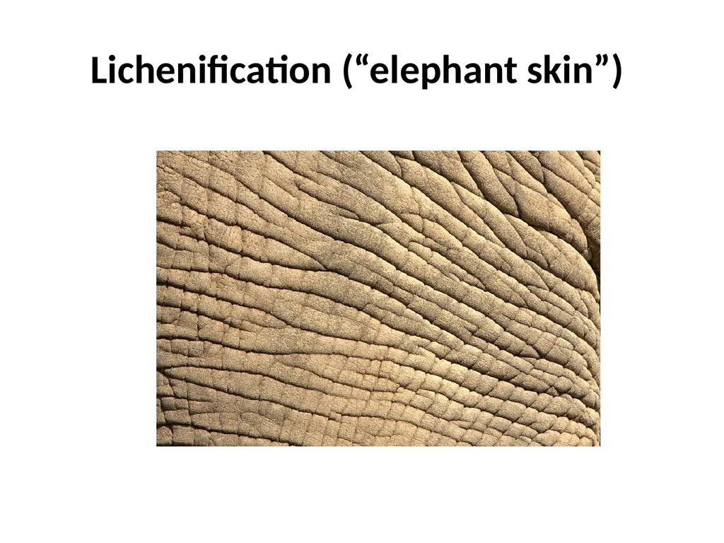 Introduction to assessing the severity of eczema - slide 21 of 40