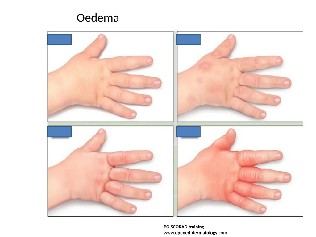 Introduction to assessing the severity of eczema - slide 10 of 40