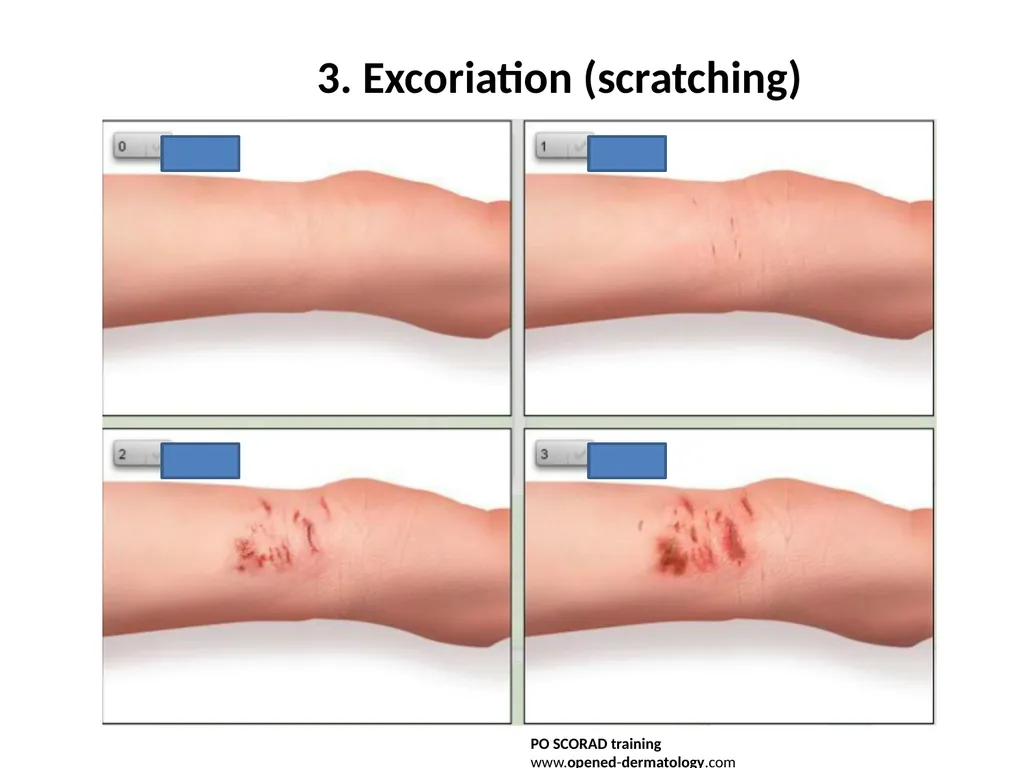 Introduction to assessing the severity of eczema - slide 16 of 40