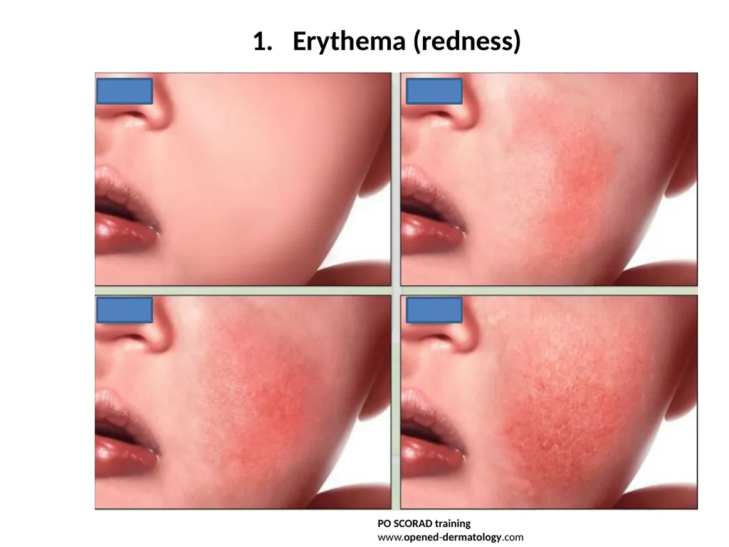 Introduction to assessing the severity of eczema - slide 8 of 40