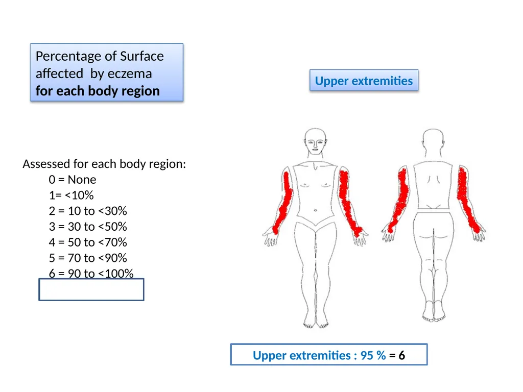 Introduction to assessing the severity of eczema - slide 37 of 40