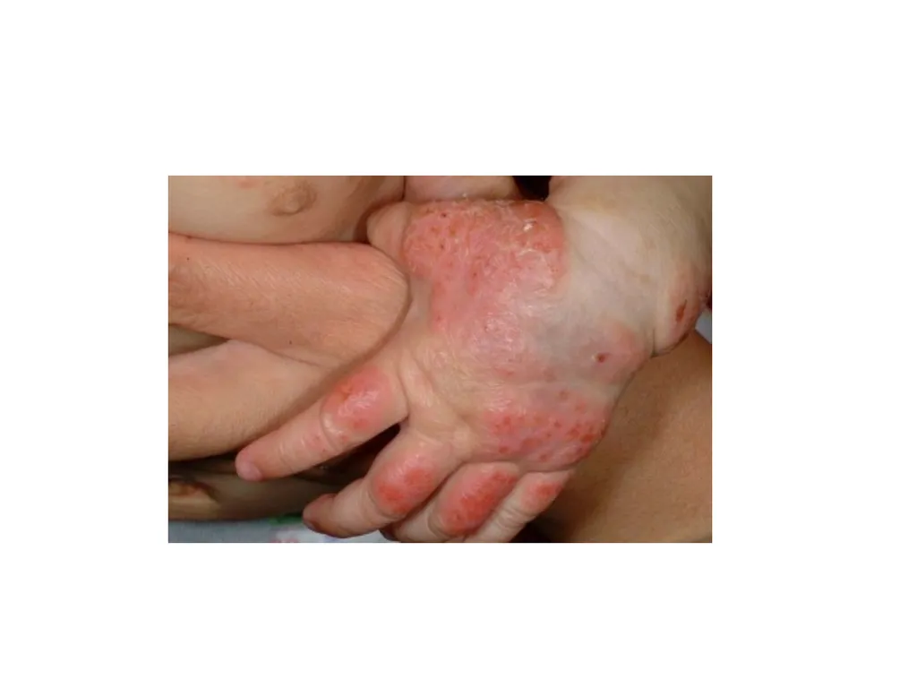 Introduction to assessing the severity of eczema - slide 11 of 40