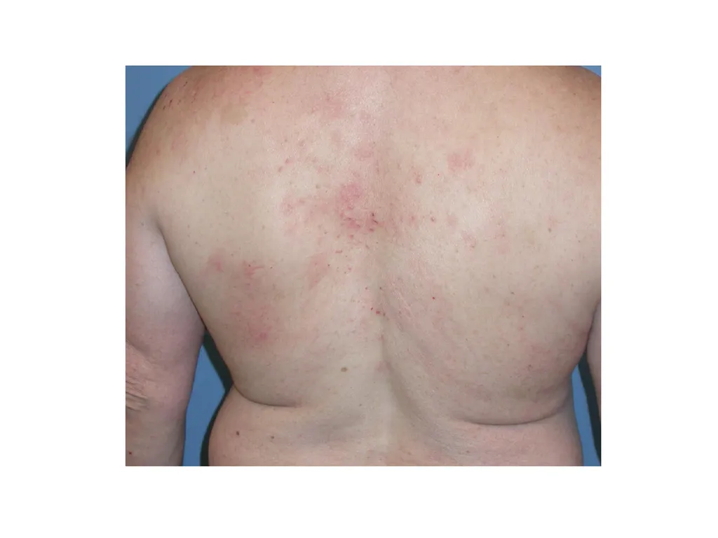 Introduction to assessing the severity of eczema - slide 12 of 40