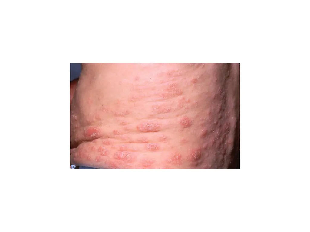 Introduction to assessing the severity of eczema - slide 13 of 40