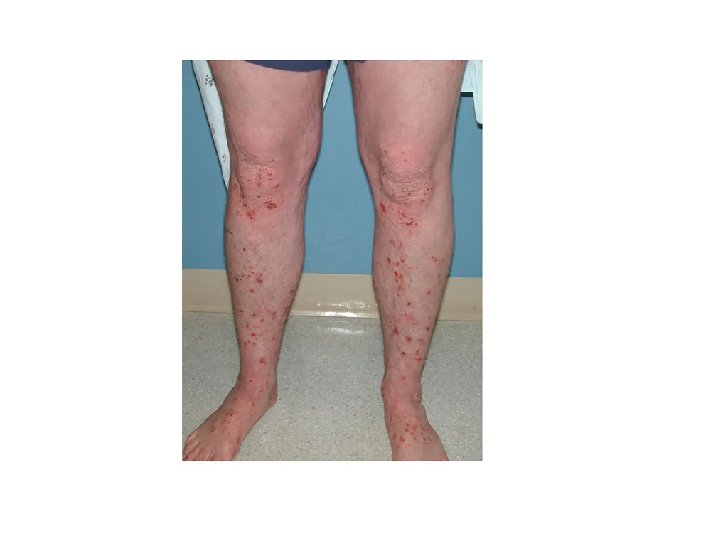 Introduction to assessing the severity of eczema - slide 17 of 40