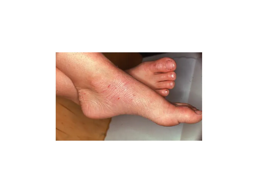 Introduction to assessing the severity of eczema - slide 22 of 40