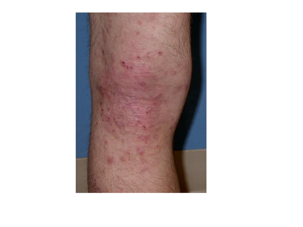 Introduction to assessing the severity of eczema - slide 23 of 40