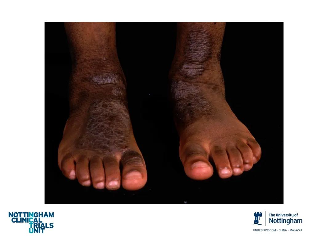 Introduction to assessing the severity of eczema - slide 24 of 40