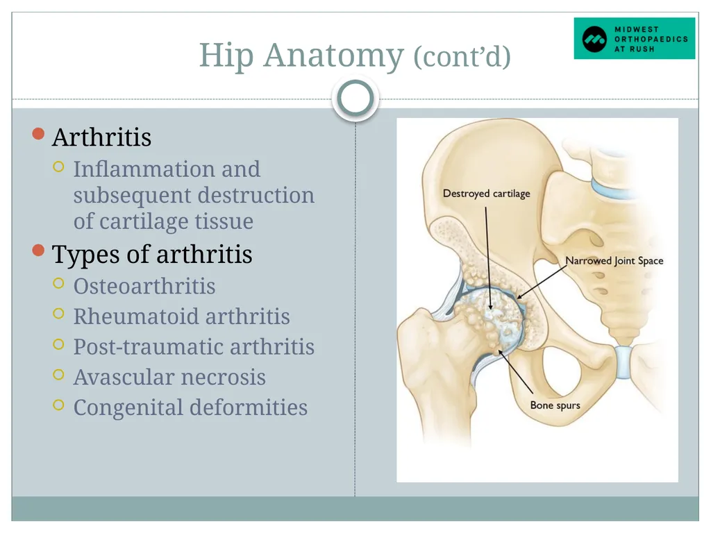 Welcome to Dr. Tad Gerlinger’s JOINT Replacement - slide 9 of 35
