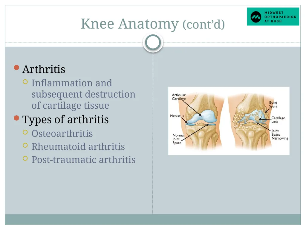 Welcome to Dr. Tad Gerlinger’s JOINT Replacement - slide 4 of 35