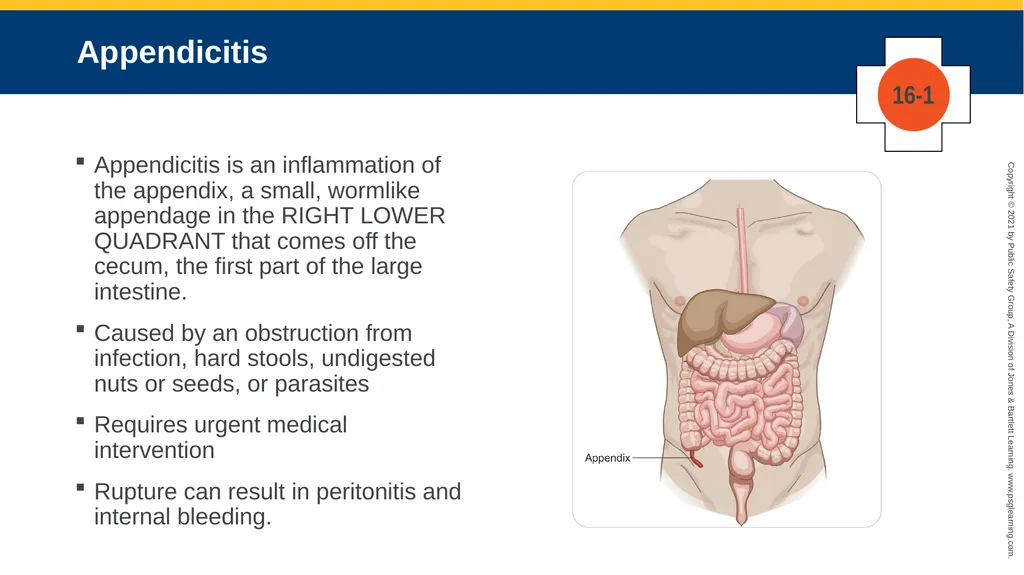 CHAPTER 16 Gastrointestinal, Genitourinary, and - slide 22 of 74