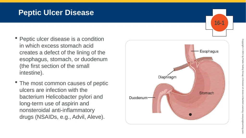 CHAPTER 16 Gastrointestinal, Genitourinary, and - slide 40 of 74