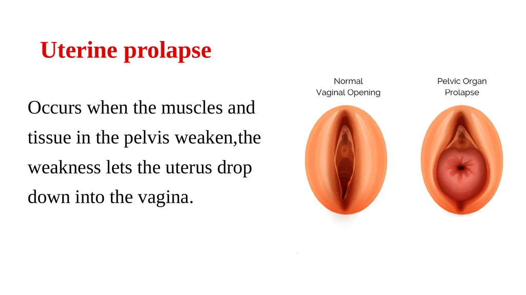 Bimanual pelvic examination Prepared by: Shaimaa - slide 11 of 22