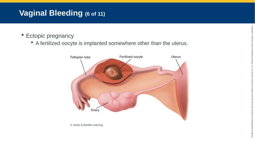 Gynecologic Emergencies CHAPTER 23 Introduction - slide 64 of 80