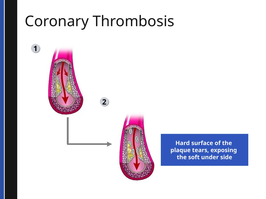 BLS 2015 Cardiovascular Emergencies Cardiovascular - slide 20 of 58
