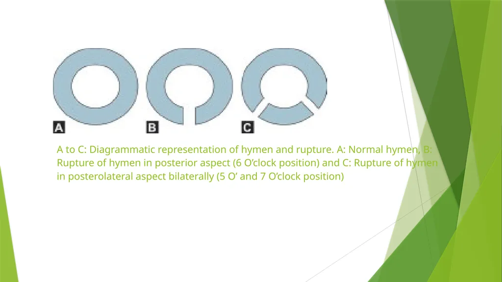 Virginity, sexual offenses and Perversions - slide 17 of 23