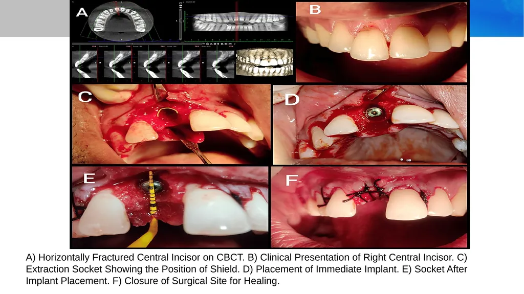 Partial Extraction Therapies (PET): Maintaining - slide 8 of 18