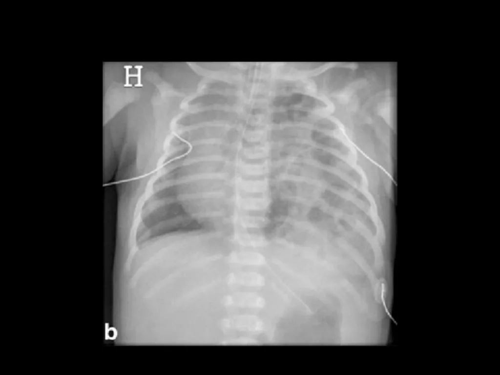 PREP Neonatal cases…. 2021 Helen Fielder Case 1 33 - slide 30 of 35