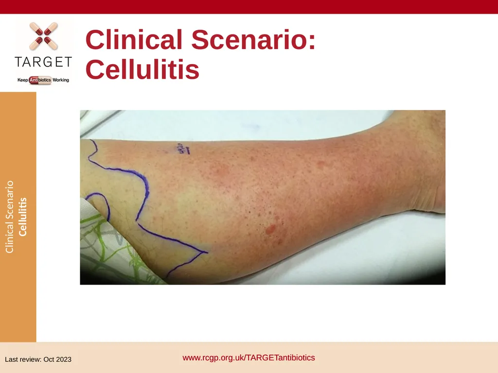 Clinical Scenario: Cellulitis People with dark - slide 1 of 17