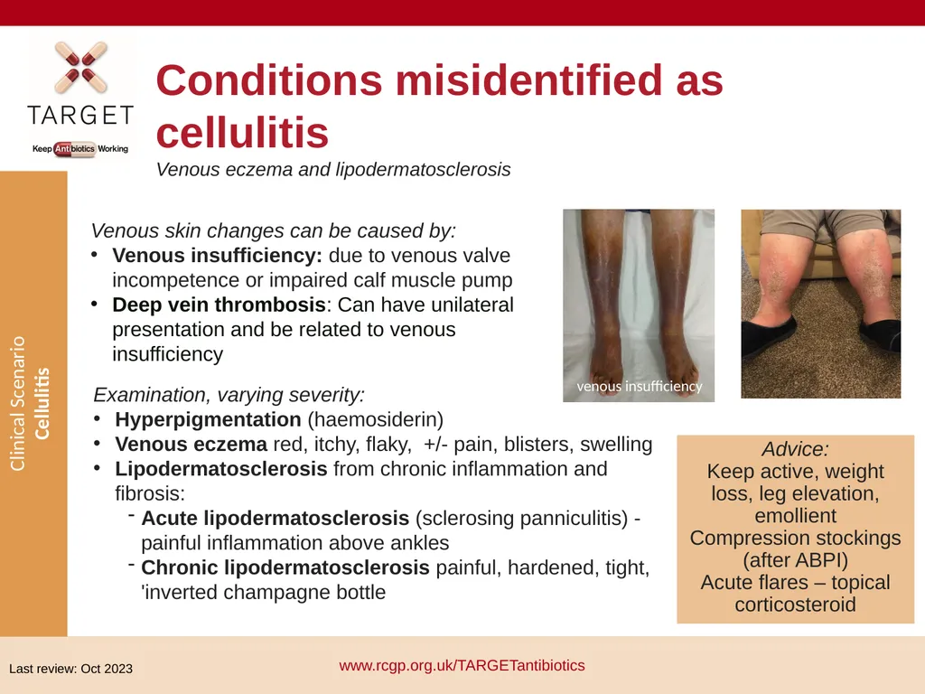 Clinical Scenario: Cellulitis People with dark - slide 4 of 17