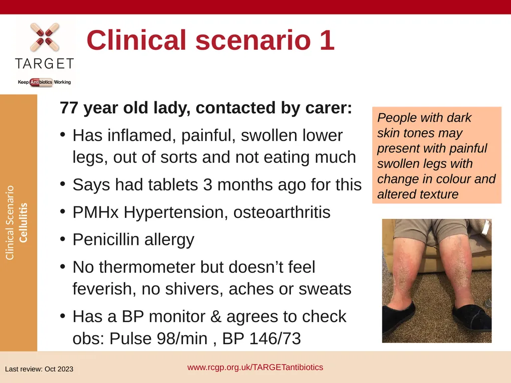 Clinical Scenario: Cellulitis People with dark - slide 2 of 17