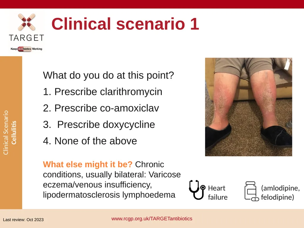 Clinical Scenario: Cellulitis People with dark - slide 3 of 17