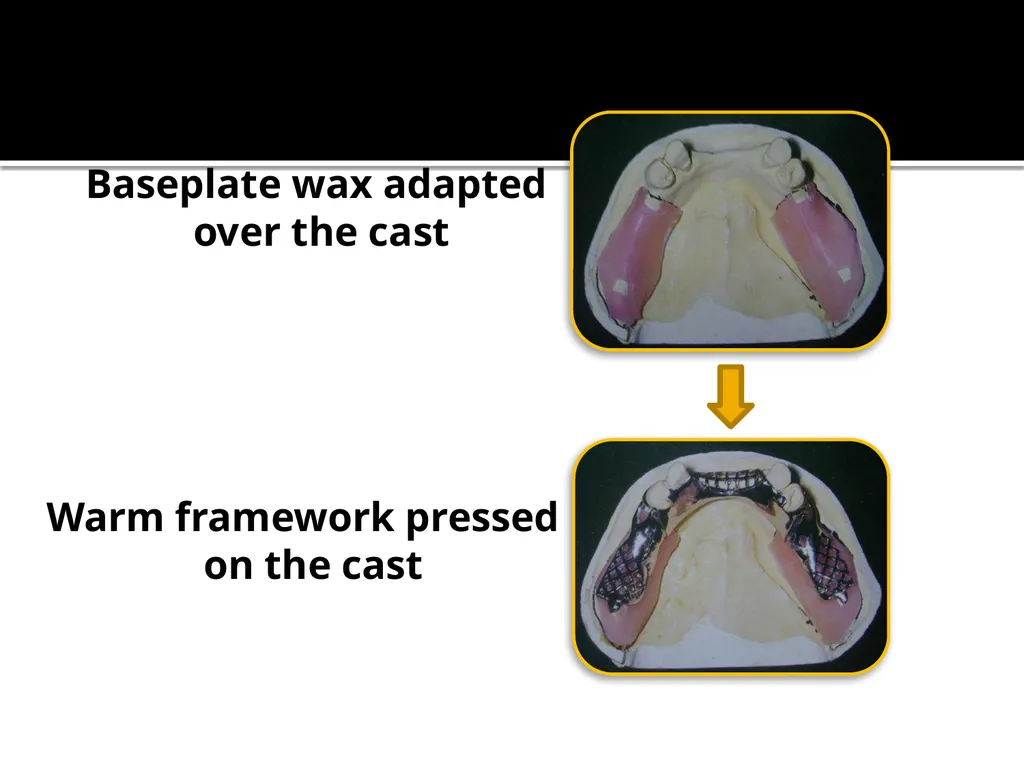 IMPRESSION PROCEDURES FOR REMOVABLE PARTIAL - slide 20 of 30