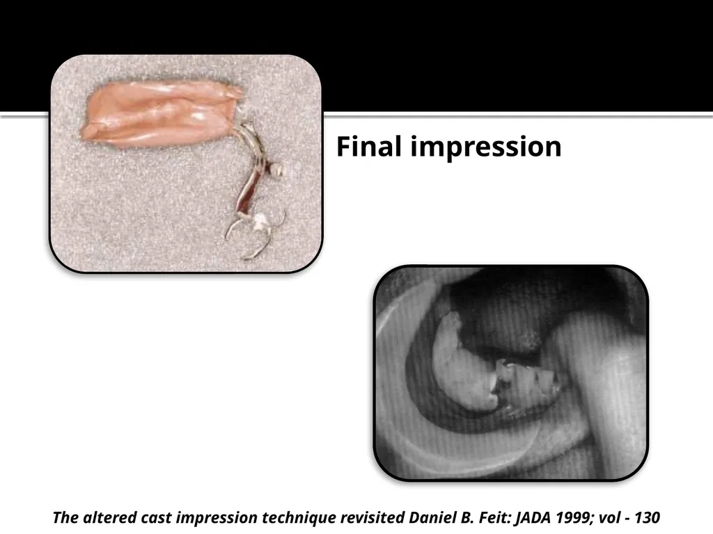 IMPRESSION PROCEDURES FOR REMOVABLE PARTIAL - slide 25 of 30