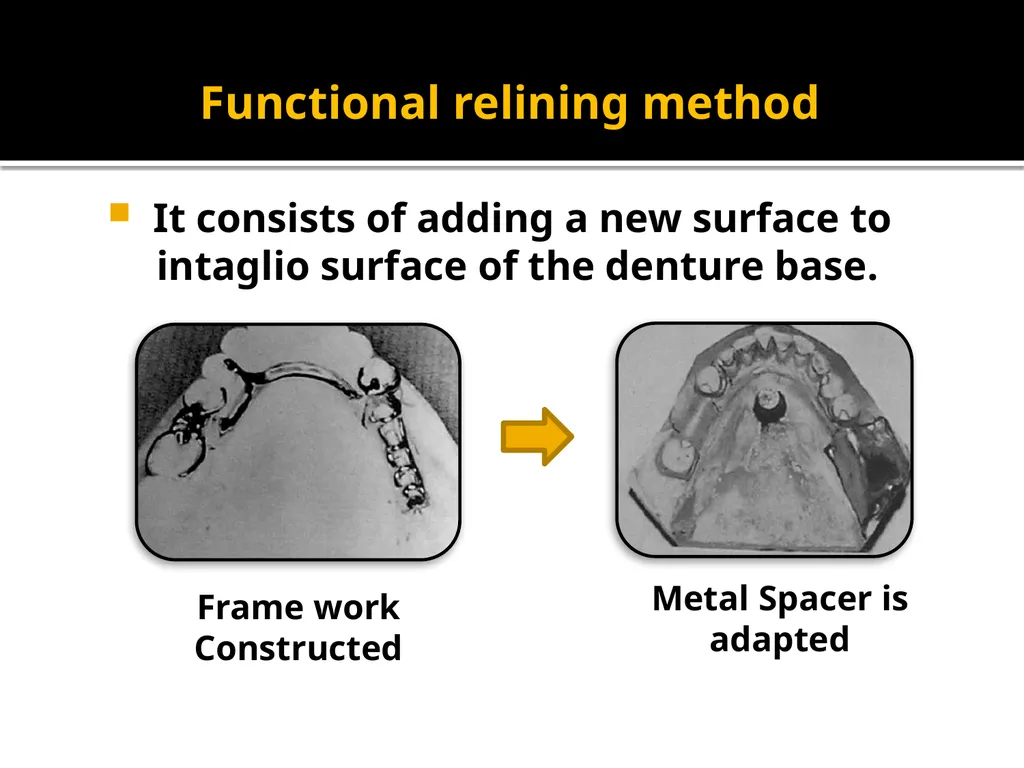 IMPRESSION PROCEDURES FOR REMOVABLE PARTIAL - slide 12 of 30