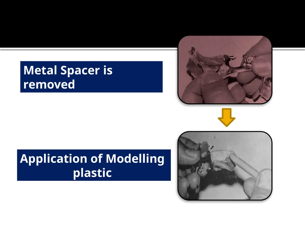 IMPRESSION PROCEDURES FOR REMOVABLE PARTIAL - slide 13 of 30