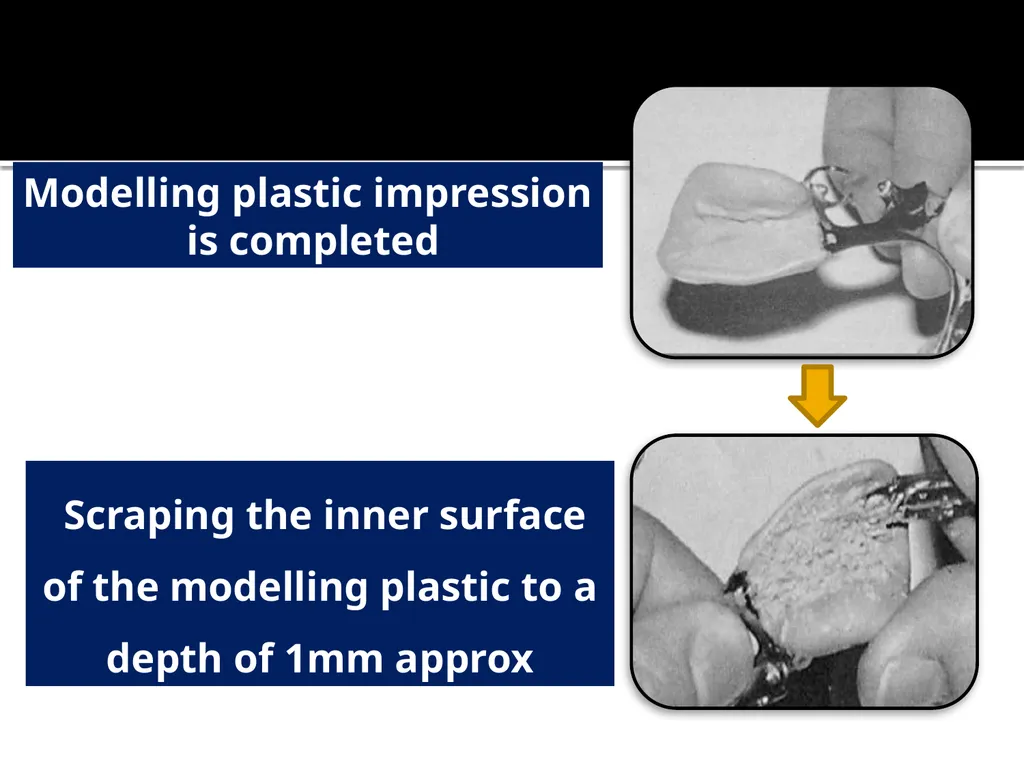 IMPRESSION PROCEDURES FOR REMOVABLE PARTIAL - slide 14 of 30
