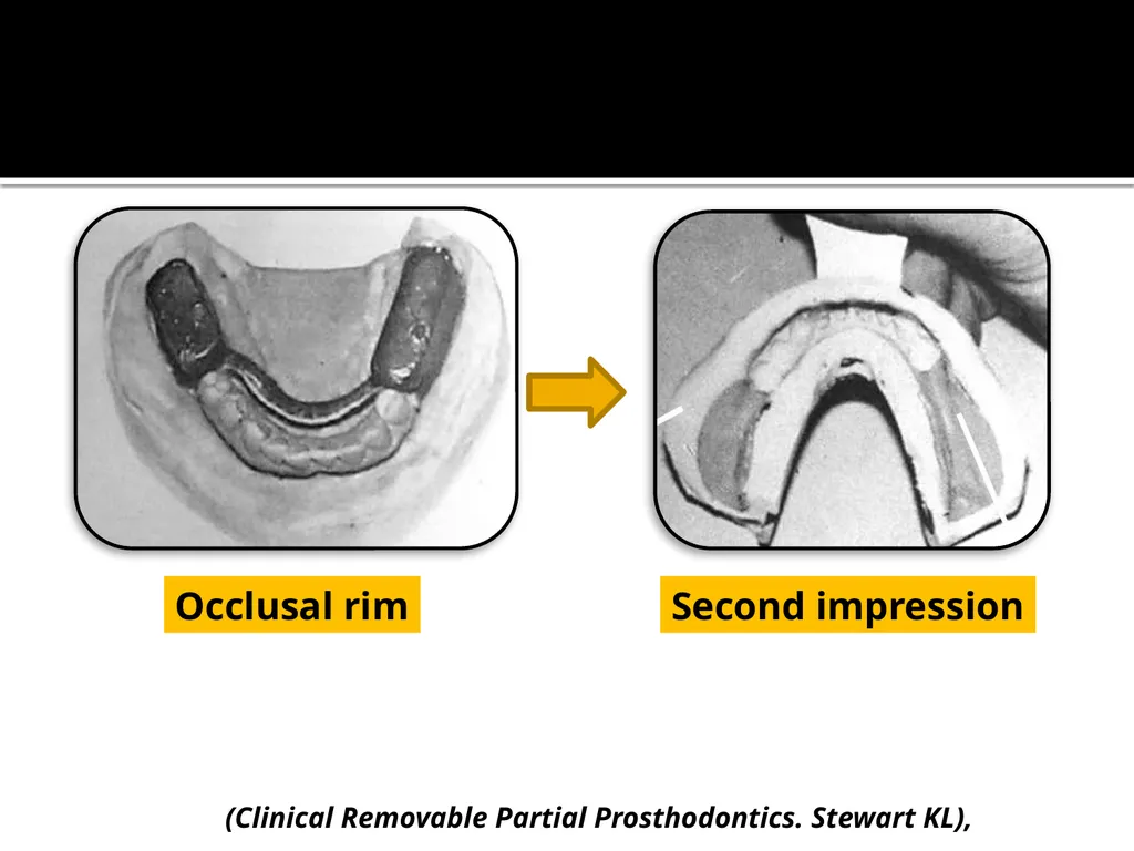 IMPRESSION PROCEDURES FOR REMOVABLE PARTIAL - slide 8 of 30