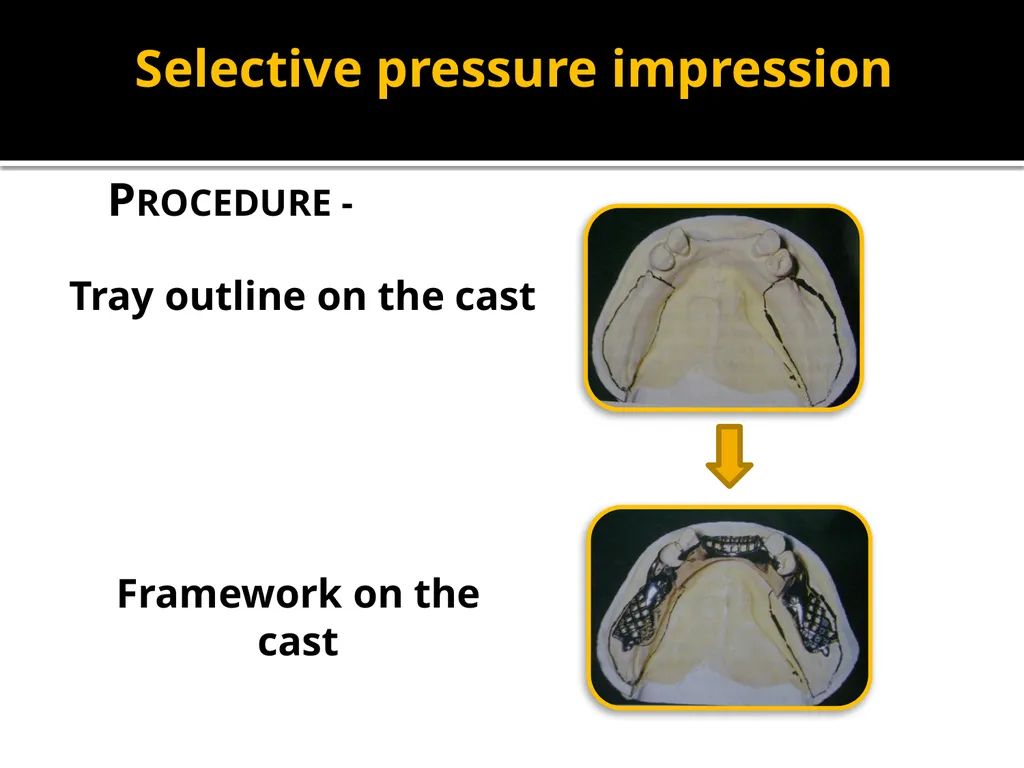 IMPRESSION PROCEDURES FOR REMOVABLE PARTIAL - slide 19 of 30
